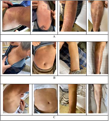 Incidentally cured psoriasis in a patient with refractory/relapsed diffuse large B-cell lymphoma receiving CD19 CAR-T cell therapy: a case report